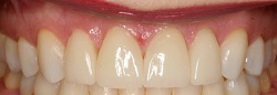 antes y despues de tratamientos dentales Caguas