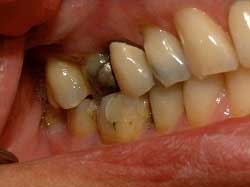 antes y despues de tratamientos dentales Caguas