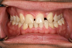 Implantes dentales Caguas
