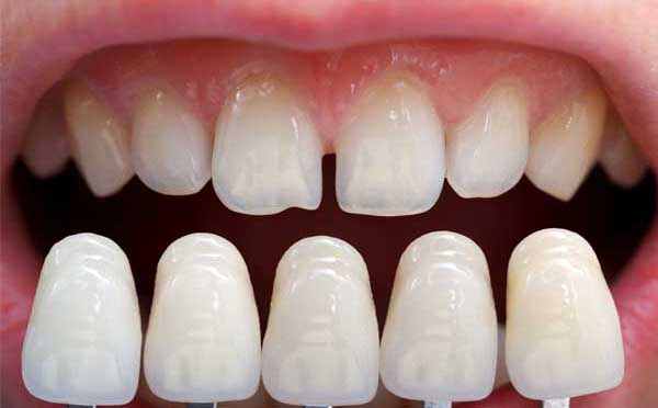 ᐈ Carillas Dentales en Santiago - Clínica Dental OnSmile